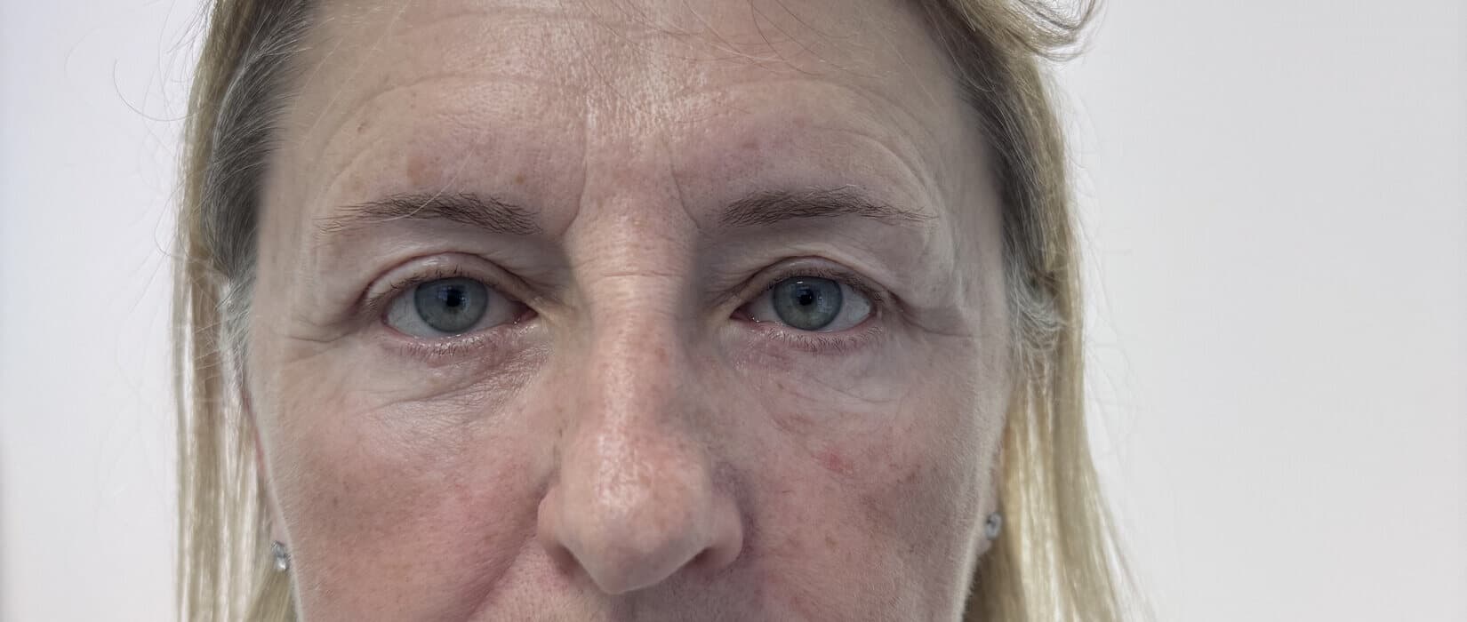 Case 001 8.5 months post-treatment frontal view for Lower OFA-Bleph™ with fat repositioning at EyeFACE Institute Toronto