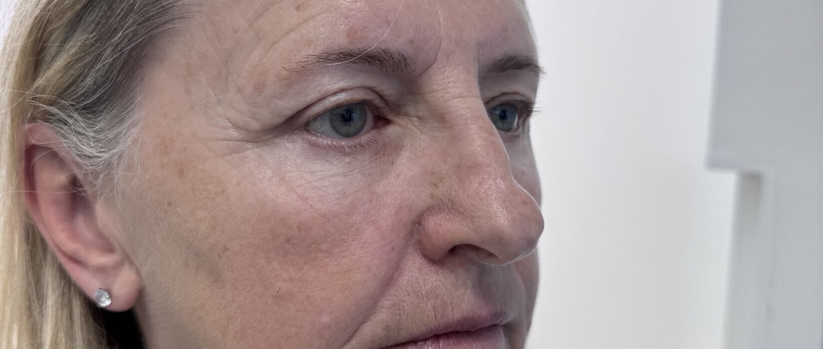Case 001 8.5 months post-treatment right oblique view for Lower OFA-Bleph™ with fat repositioning at EyeFACE Institute Toronto
