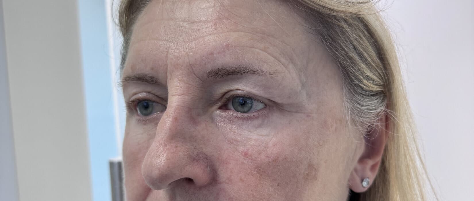 Case 001 8.5 months post-treatment left oblique view for Lower OFA-Bleph™ with fat repositioning at EyeFACE Institute Toronto