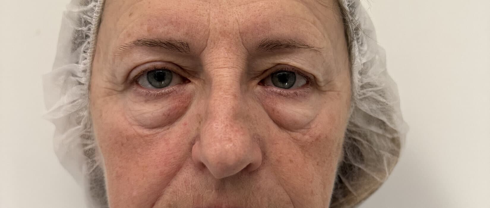 Case 001 pre-treatment frontal view for Lower OFA-Bleph™ with fat repositioning at EyeFACE Institute Toronto