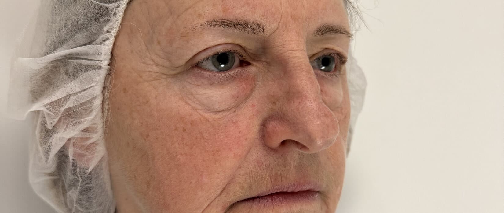 Case 001 pre-treatment right oblique view for Lower OFA-Bleph™ with fat repositioning at EyeFACE Institute Toronto
