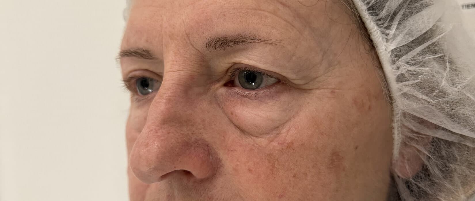Case 001 pre-treatment left oblique view for Lower OFA-Bleph™ with fat repositioning at EyeFACE Institute Toronto