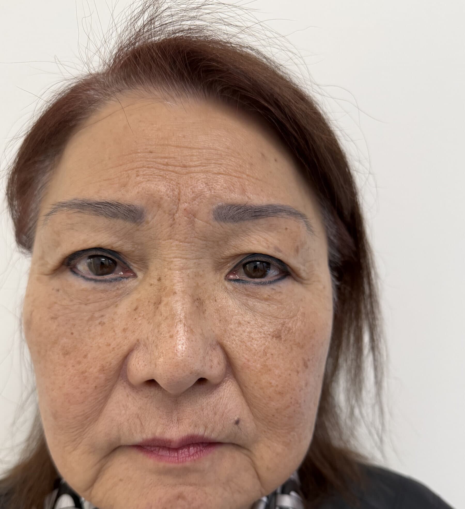 Case 002 5 months post-treatment frontal hairline-to-chin view for Four-lid OFA-Bleph™ with ptosis repair and RERF-M support at EyeFACE Institute Toronto