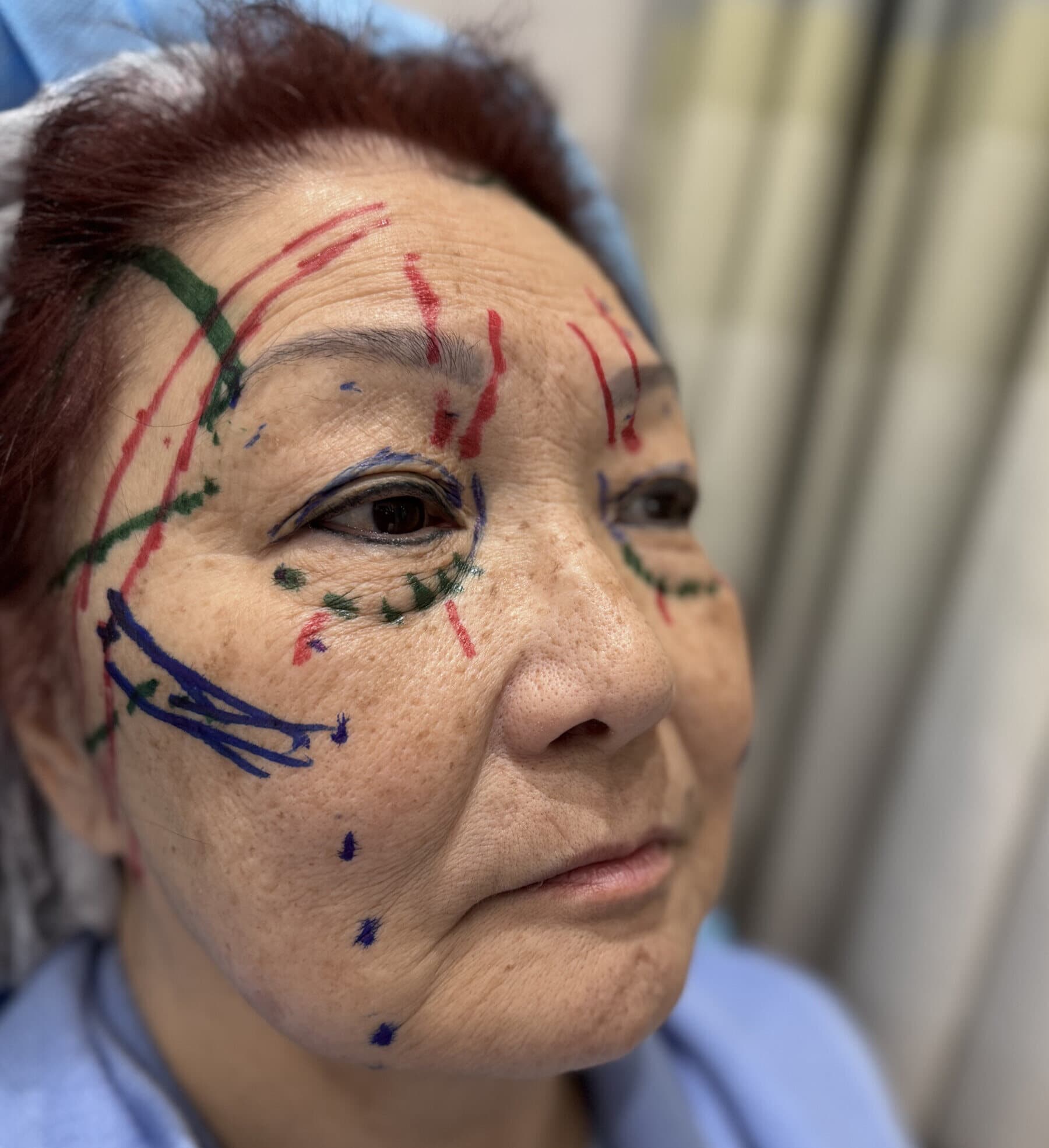Case 002 pre-treatment planning oblique hairline-to-chin view for Four-lid OFA-Bleph™ with ptosis repair and RERF-M support at EyeFACE Institute Toronto