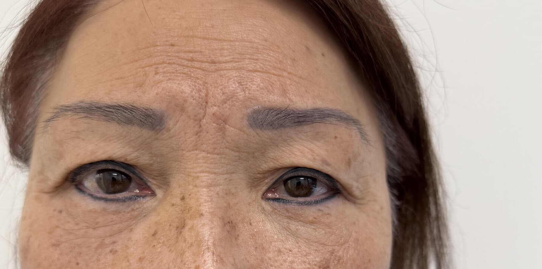 post-treatment four-lid OFA-Bleph and RERF-M educational example for eyelid architecture and under-eye support at EyeFACE Institute Toronto