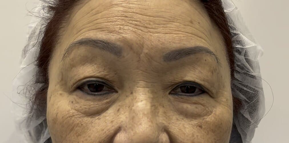 pre-treatment four-lid OFA-Bleph and RERF-M educational example for eyelid architecture and under-eye support at EyeFACE Institute Toronto