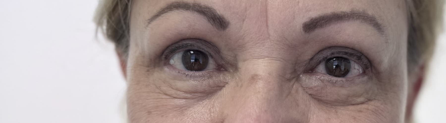 Case 003 3 months post-treatment frontal periocular view for Upper OFA-Bleph™ with conservative periocular presentation at EyeFACE Institute Toronto