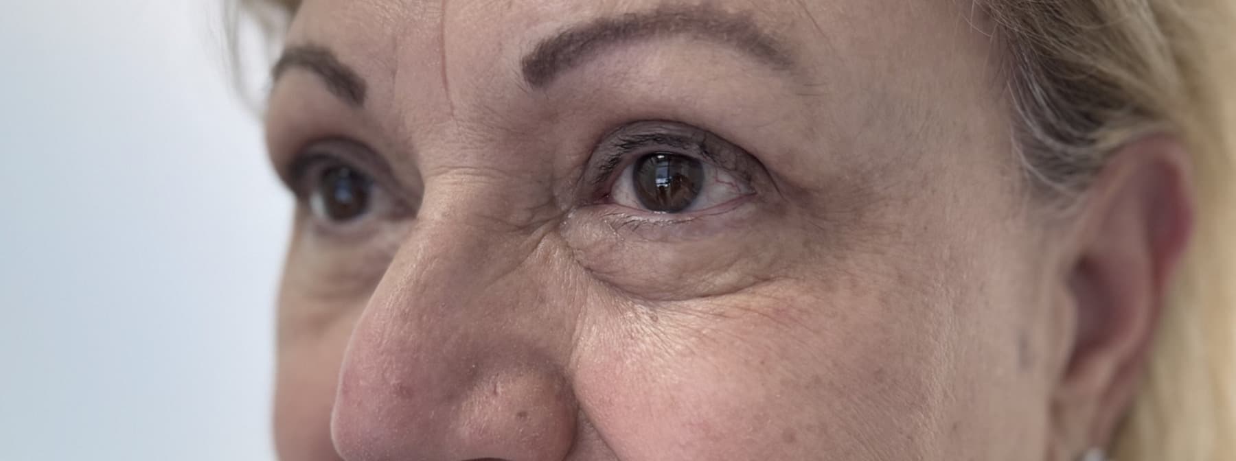 Case 003 3 months post-treatment left oblique periocular view for Upper OFA-Bleph™ with conservative periocular presentation at EyeFACE Institute Toronto