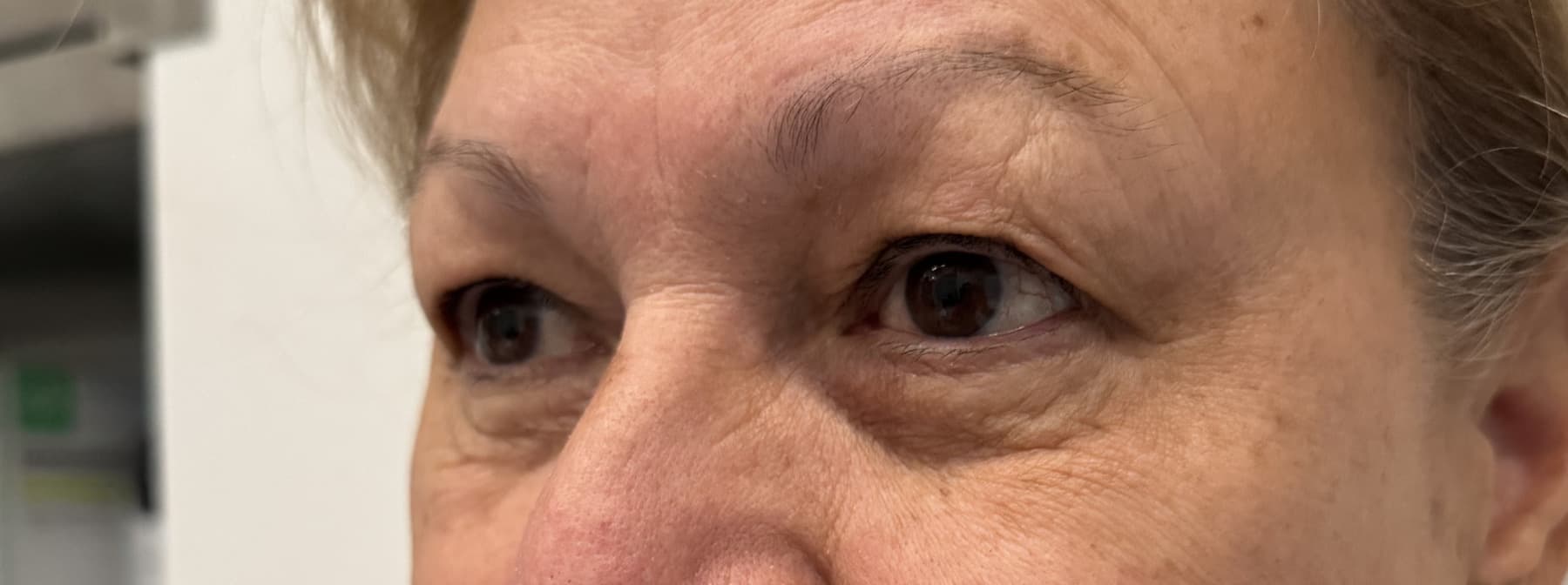 Case 003 pre-treatment left oblique periocular view for Upper OFA-Bleph™ with conservative periocular presentation at EyeFACE Institute Toronto